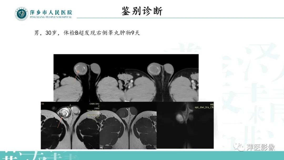 影像PPT - 【PPT】睾丸精原细胞瘤-18