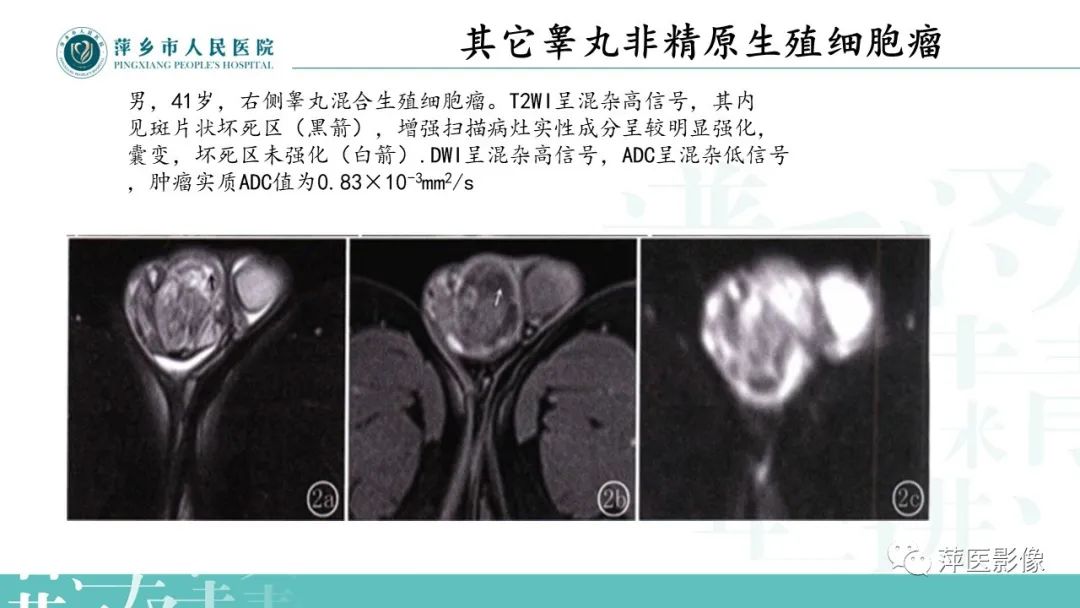 影像PPT - 【PPT】睾丸精原细胞瘤-22