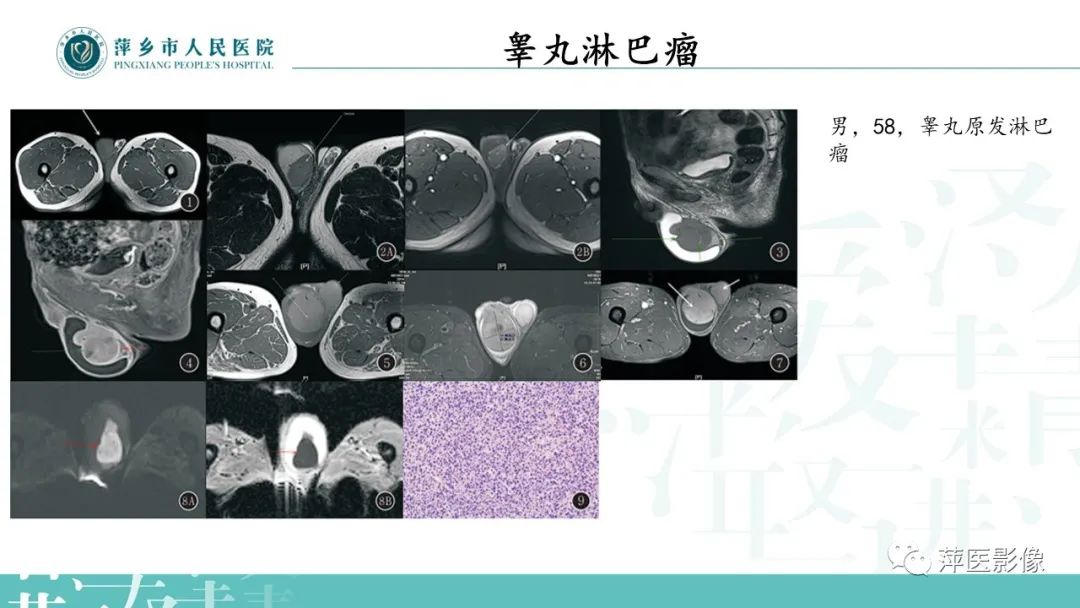 影像PPT - 【PPT】睾丸精原细胞瘤-24
