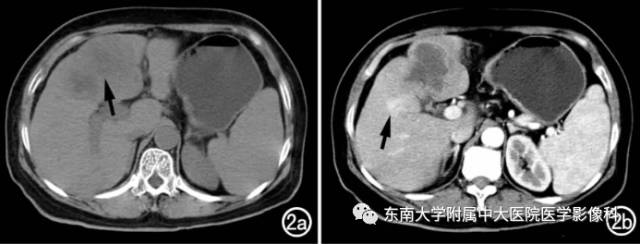 影像PPT - 囊性肝内胆管细胞癌ICC与肝脓肿鉴别-3 影像PPT - 囊性肝内胆管细胞癌ICC与肝脓肿鉴别-3