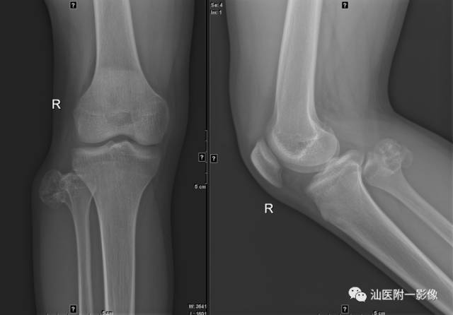 影像PPT - 软骨类肿瘤主要内容回顾-5 影像PPT - 软骨类肿瘤主要内容回顾-5