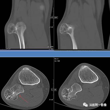 影像PPT - 软骨类肿瘤主要内容回顾-6 影像PPT - 软骨类肿瘤主要内容回顾-6