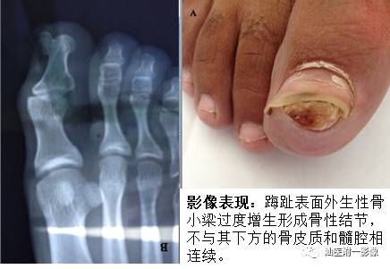 影像PPT - 软骨类肿瘤主要内容回顾-13 影像PPT - 软骨类肿瘤主要内容回顾-13