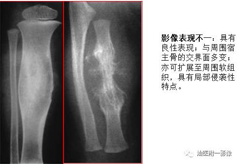 影像PPT - 软骨类肿瘤主要内容回顾-12 影像PPT - 软骨类肿瘤主要内容回顾-12