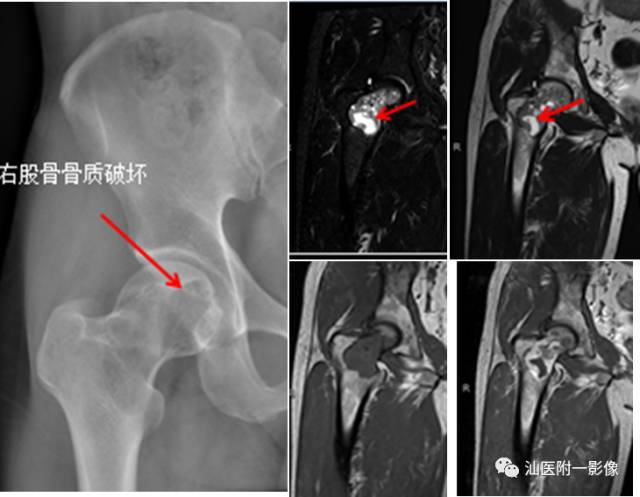 影像PPT - 软骨类肿瘤主要内容回顾-19 影像PPT - 软骨类肿瘤主要内容回顾-19