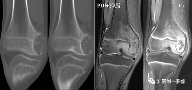 影像PPT - 软骨类肿瘤主要内容回顾-21 影像PPT - 软骨类肿瘤主要内容回顾-21