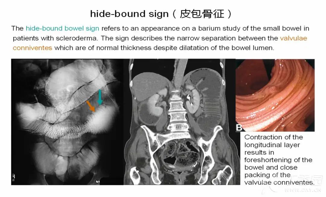 影像PPT - 皮包骨征-1