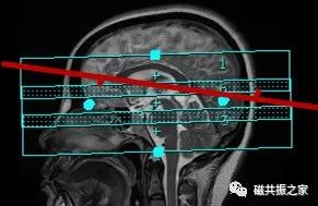 影像PPT - 颅内3D TOF-MRA成像中的几个技术要点-2 影像PPT - 颅内3D TOF-MRA成像中的几个技术要点-2