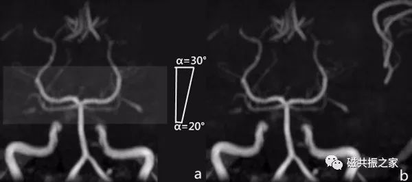 影像PPT - 颅内3D TOF-MRA成像中的几个技术要点-5 影像PPT - 颅内3D TOF-MRA成像中的几个技术要点-5