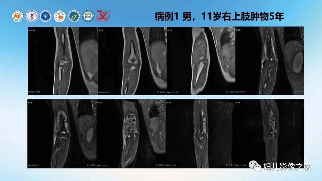 影像PPT - 【PPT】Disco成像技术在儿童血管瘤及脉管畸形的应用价值-11