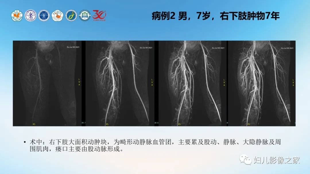 影像PPT - 【PPT】Disco成像技术在儿童血管瘤及脉管畸形的应用价值-13