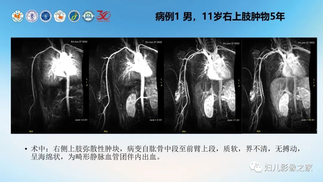 影像PPT - 【PPT】Disco成像技术在儿童血管瘤及脉管畸形的应用价值-12