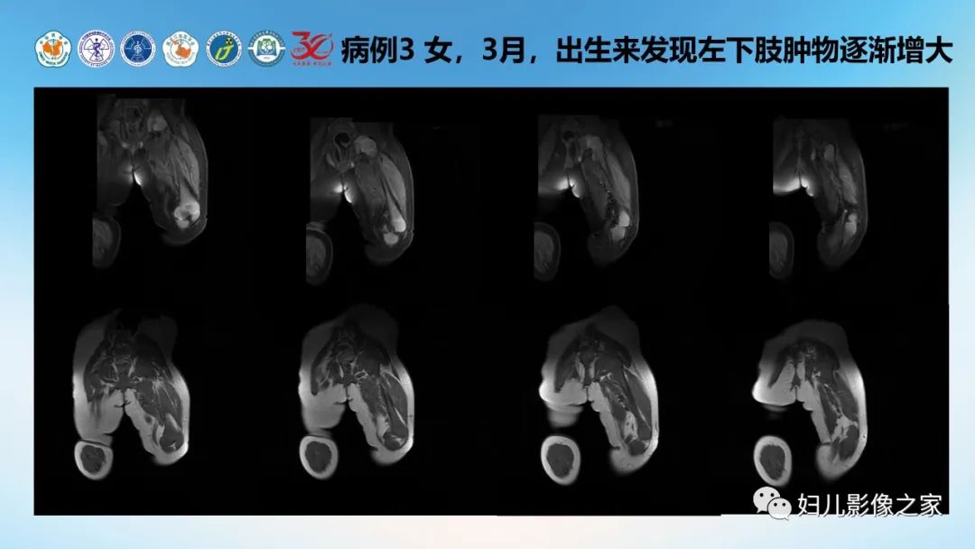影像PPT - 【PPT】Disco成像技术在儿童血管瘤及脉管畸形的应用价值-14