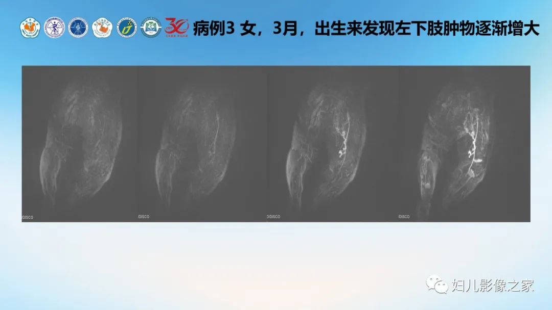 影像PPT - 【PPT】Disco成像技术在儿童血管瘤及脉管畸形的应用价值-15