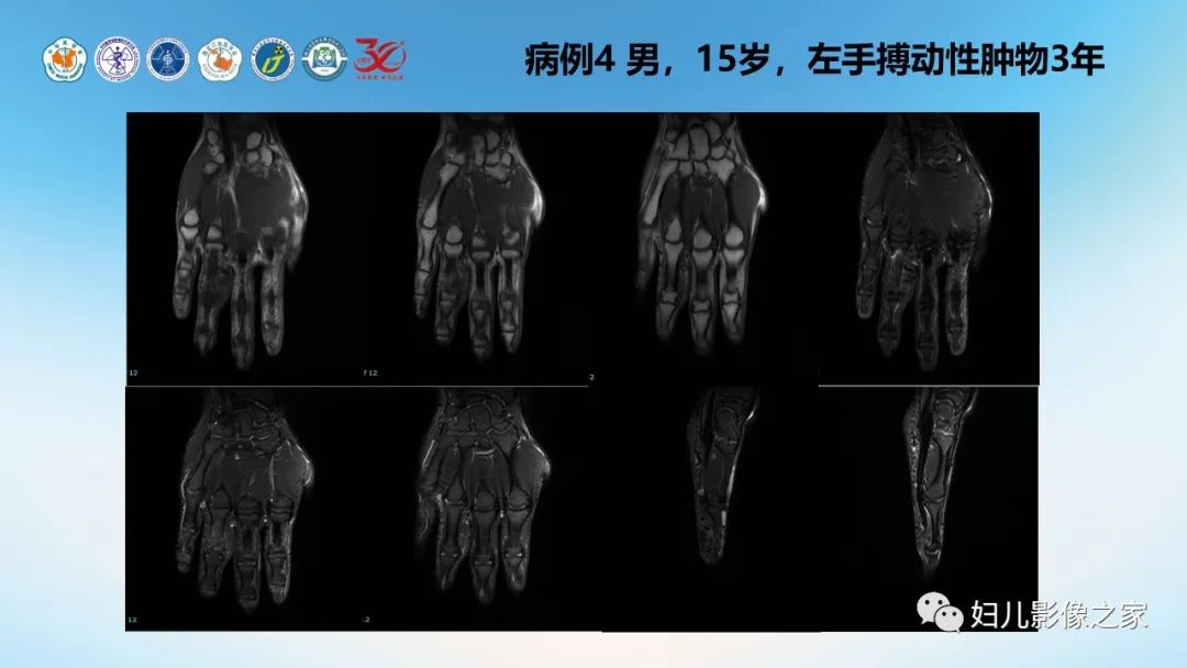 影像PPT - 【PPT】Disco成像技术在儿童血管瘤及脉管畸形的应用价值-16