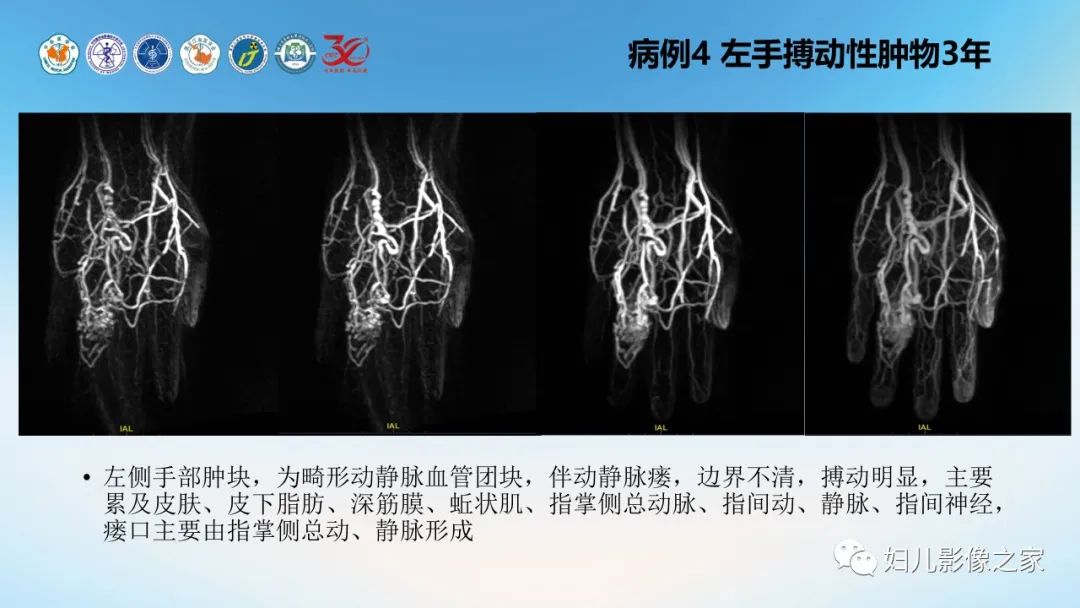 影像PPT - 【PPT】Disco成像技术在儿童血管瘤及脉管畸形的应用价值-17