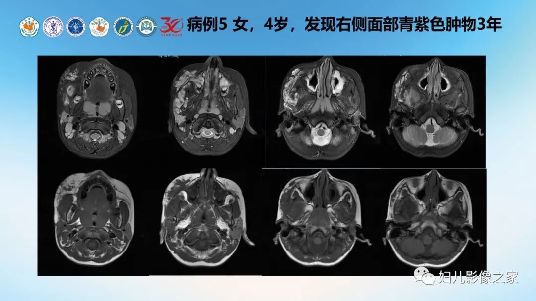 影像PPT - 【PPT】Disco成像技术在儿童血管瘤及脉管畸形的应用价值-18