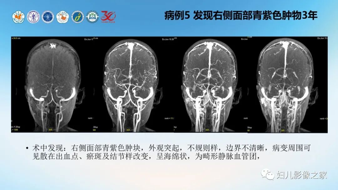 影像PPT - 【PPT】Disco成像技术在儿童血管瘤及脉管畸形的应用价值-19