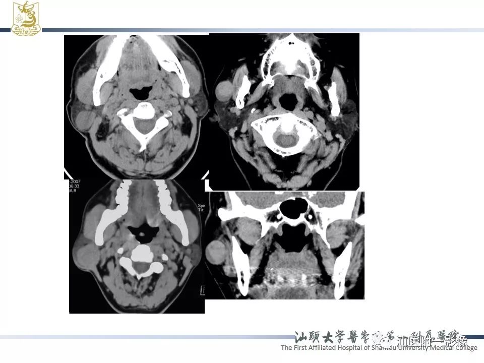 影像PPT - 【PPT】腮腺病变CT诊断-5
