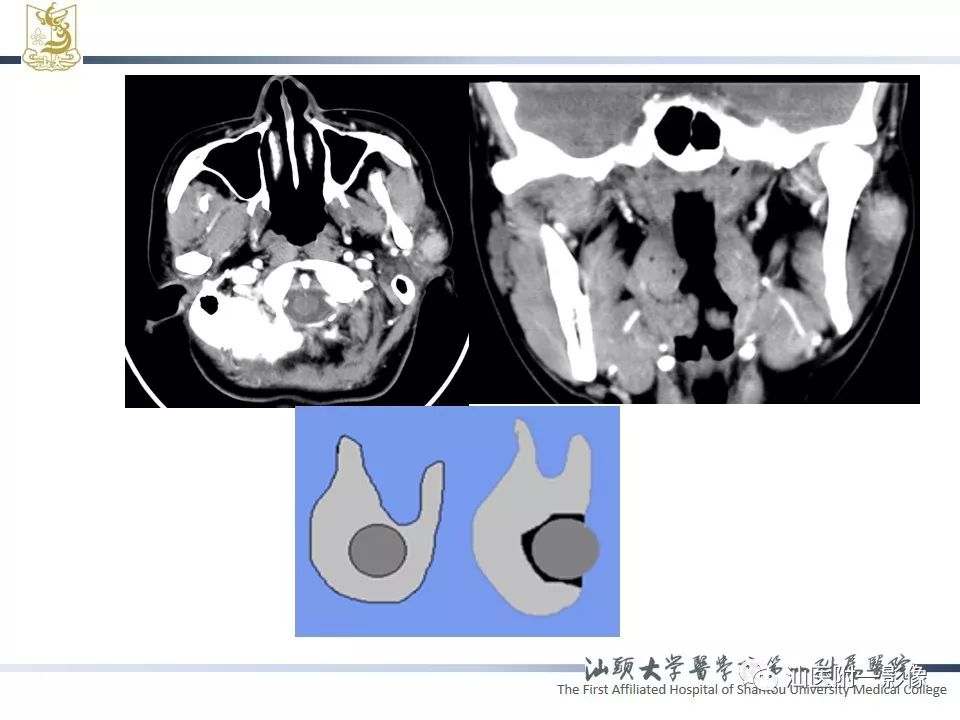 影像PPT - 【PPT】腮腺病变CT诊断-6