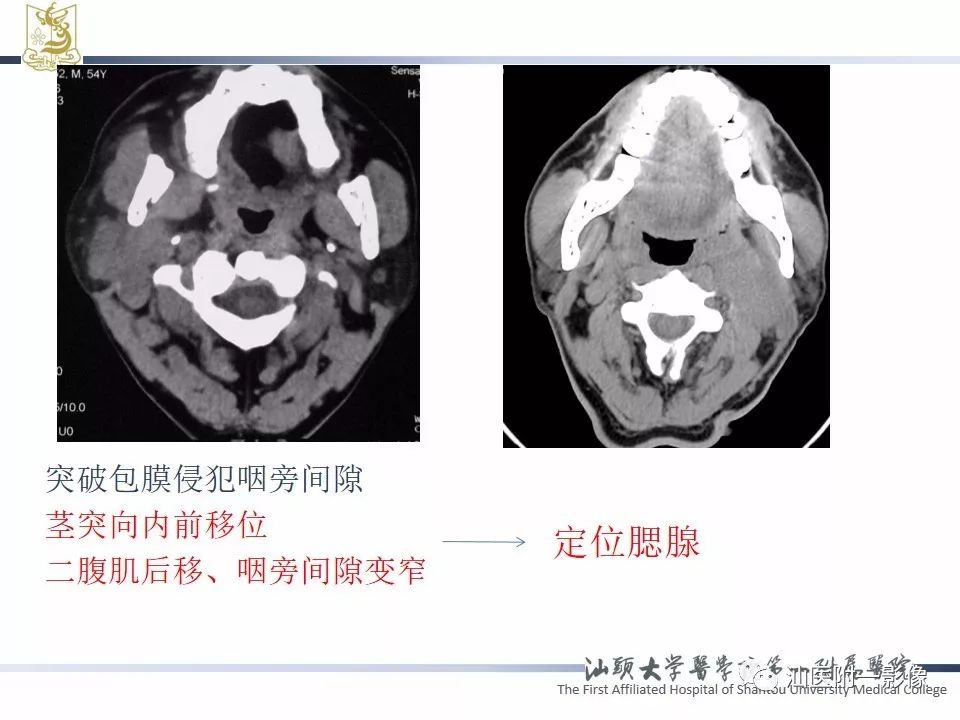 影像PPT - 【PPT】腮腺病变CT诊断-7