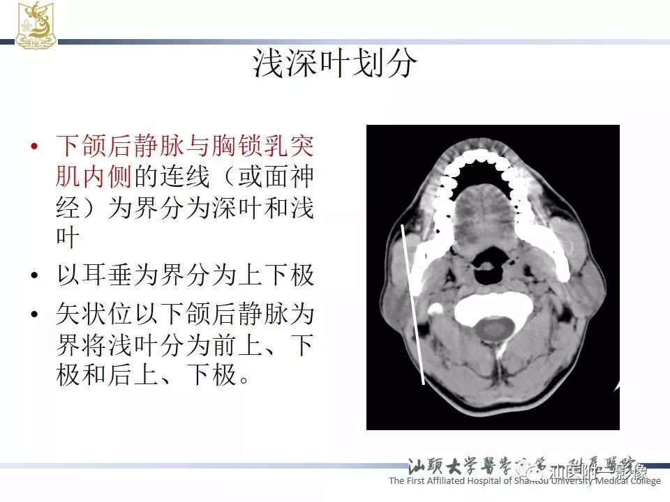 影像PPT - 【PPT】腮腺病变CT诊断-8