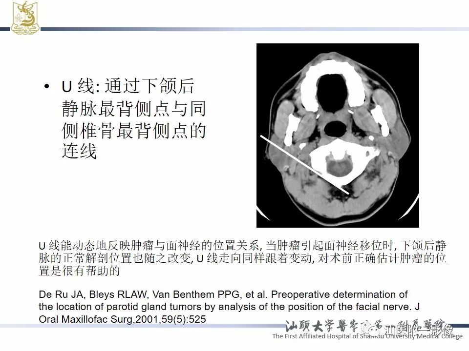 影像PPT - 【PPT】腮腺病变CT诊断-9