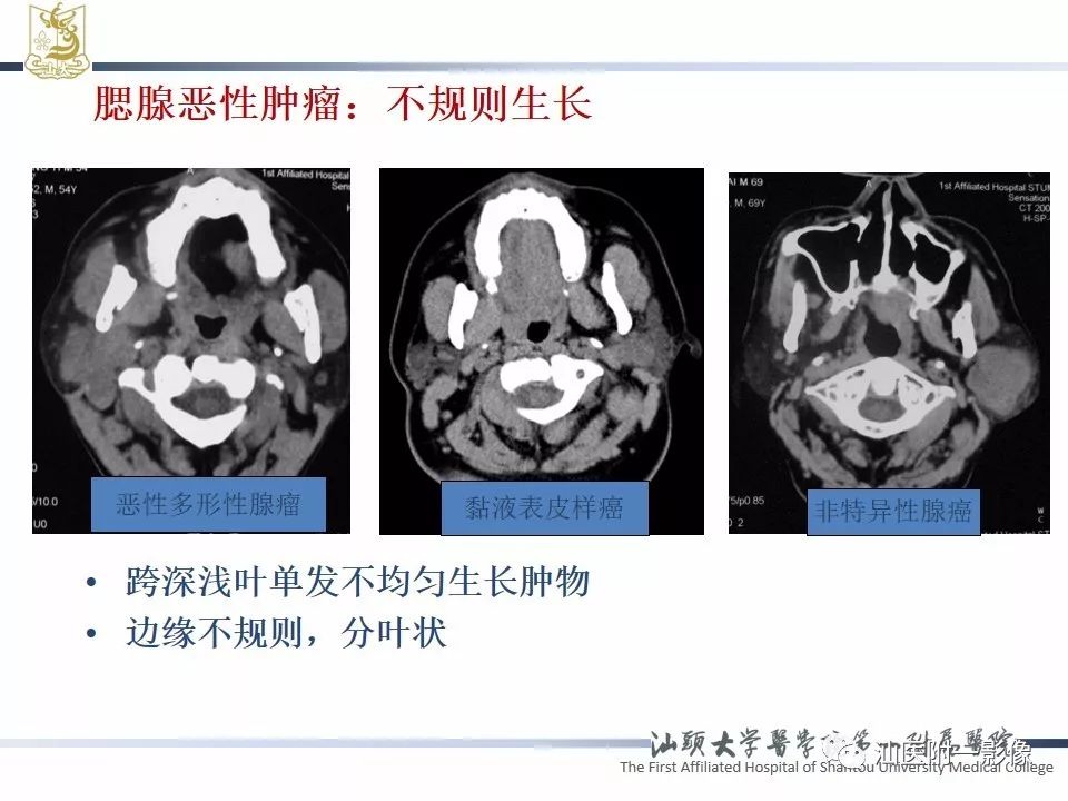 影像PPT - 【PPT】腮腺病变CT诊断-17