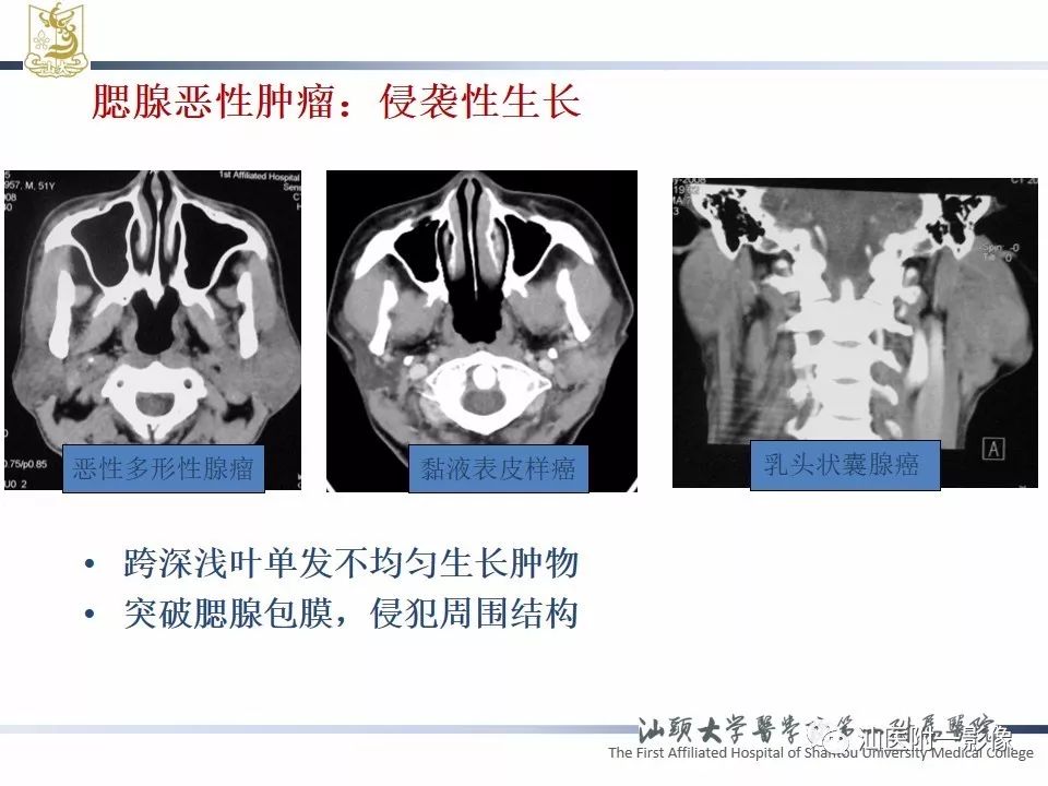 影像PPT - 【PPT】腮腺病变CT诊断-18