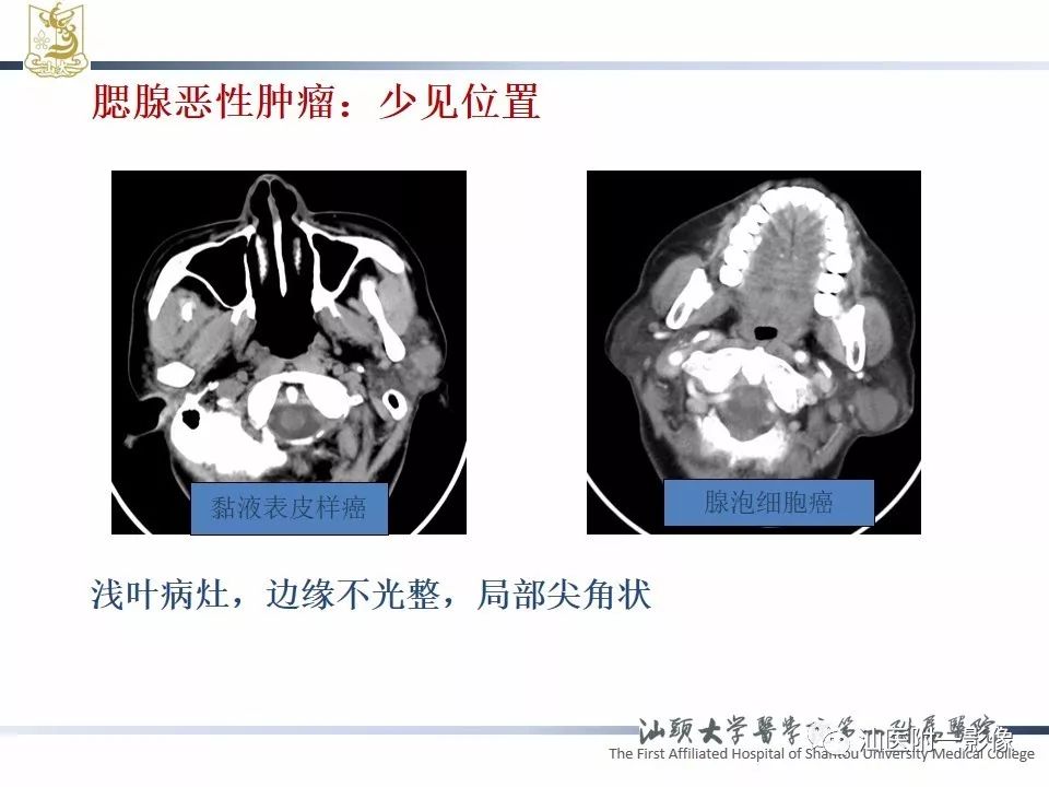 影像PPT - 【PPT】腮腺病变CT诊断-19