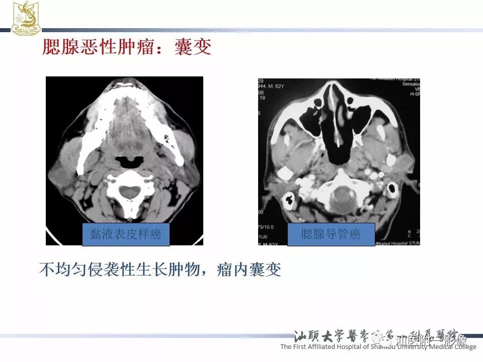 影像PPT - 【PPT】腮腺病变CT诊断-20