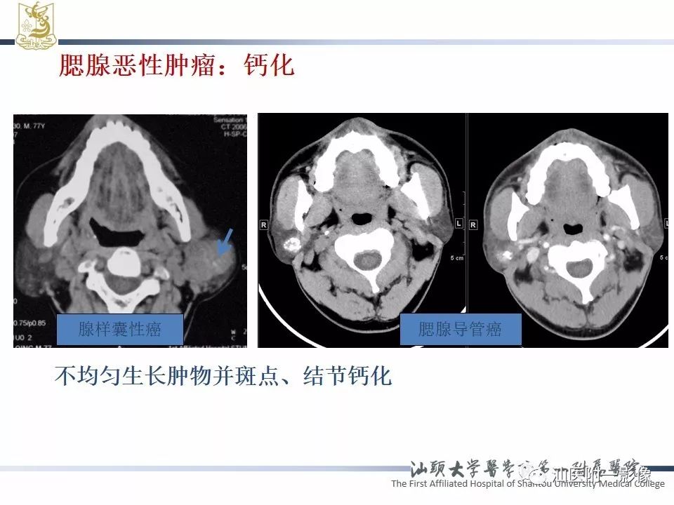 影像PPT - 【PPT】腮腺病变CT诊断-21