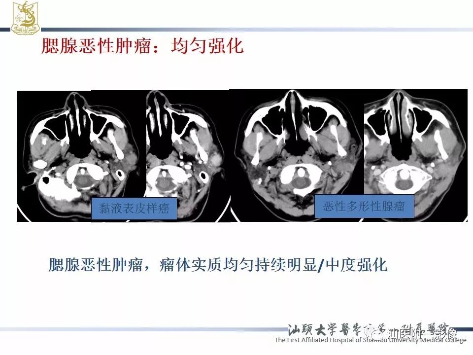 影像PPT - 【PPT】腮腺病变CT诊断-22