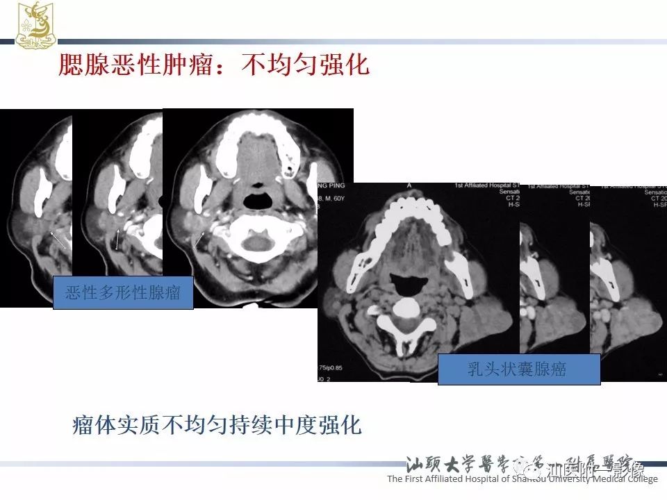 影像PPT - 【PPT】腮腺病变CT诊断-23