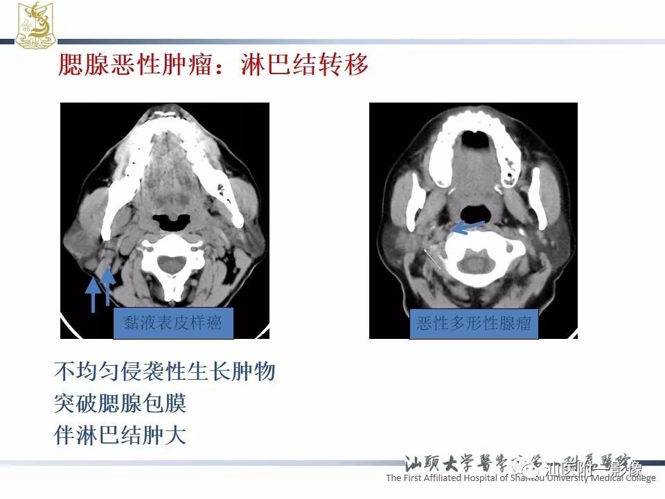 影像PPT - 【PPT】腮腺病变CT诊断-24