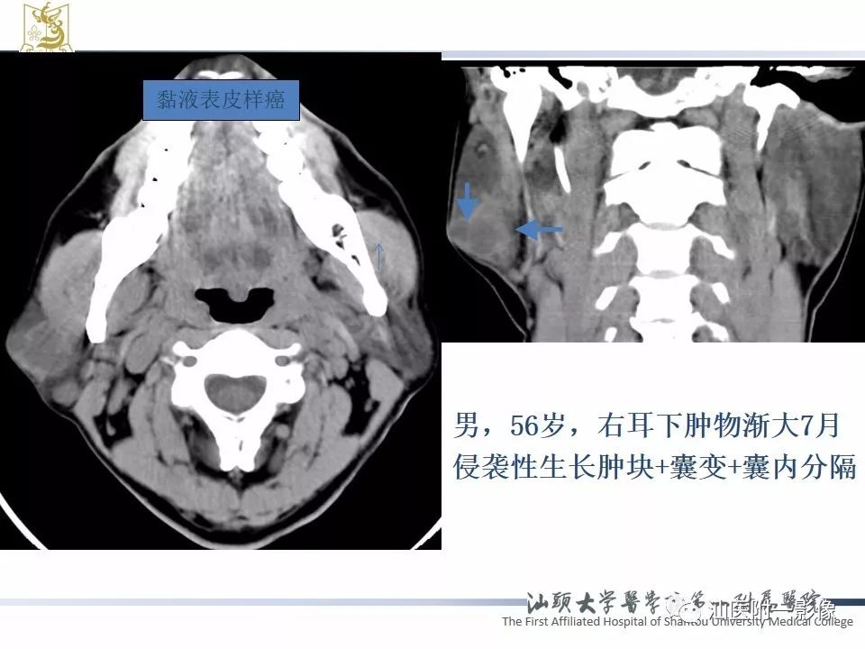 影像PPT - 【PPT】腮腺病变CT诊断-27