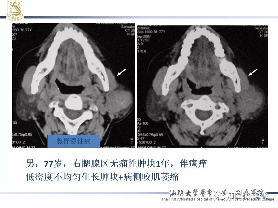 影像PPT - 【PPT】腮腺病变CT诊断-28