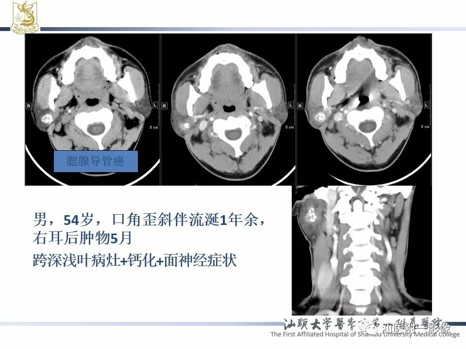 影像PPT - 【PPT】腮腺病变CT诊断-29