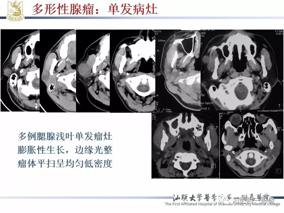 影像PPT - 【PPT】腮腺病变CT诊断-36