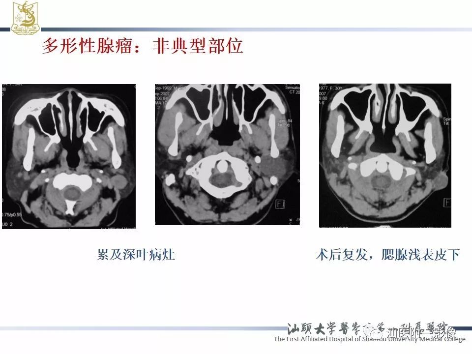 影像PPT - 【PPT】腮腺病变CT诊断-37