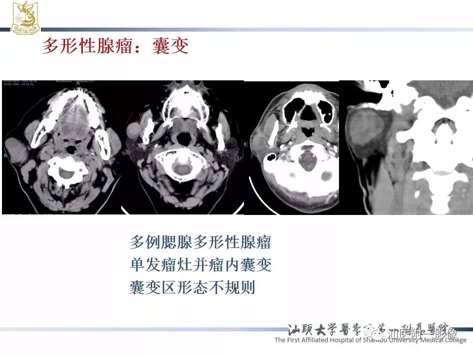 影像PPT - 【PPT】腮腺病变CT诊断-38