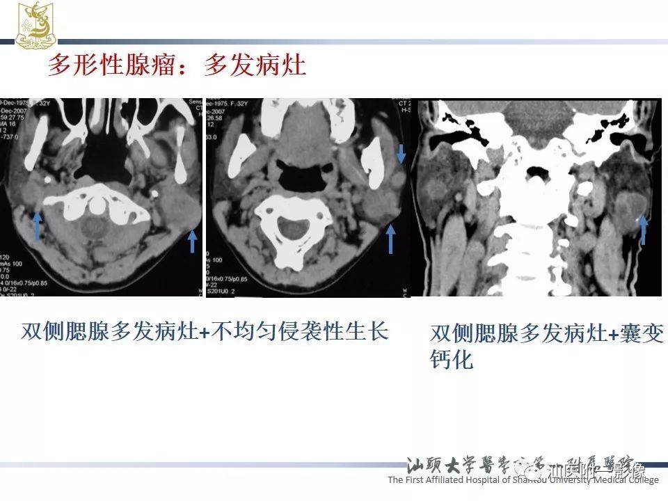 影像PPT - 【PPT】腮腺病变CT诊断-39