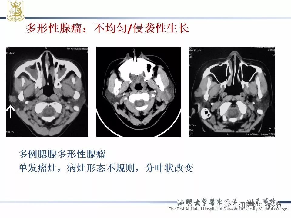 影像PPT - 【PPT】腮腺病变CT诊断-40