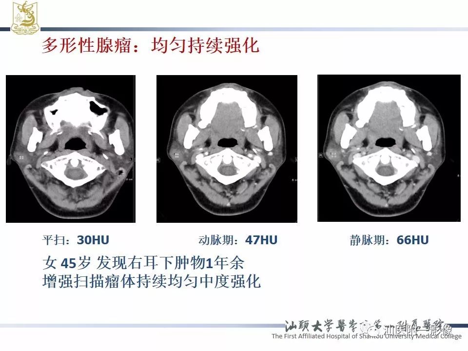 影像PPT - 【PPT】腮腺病变CT诊断-41