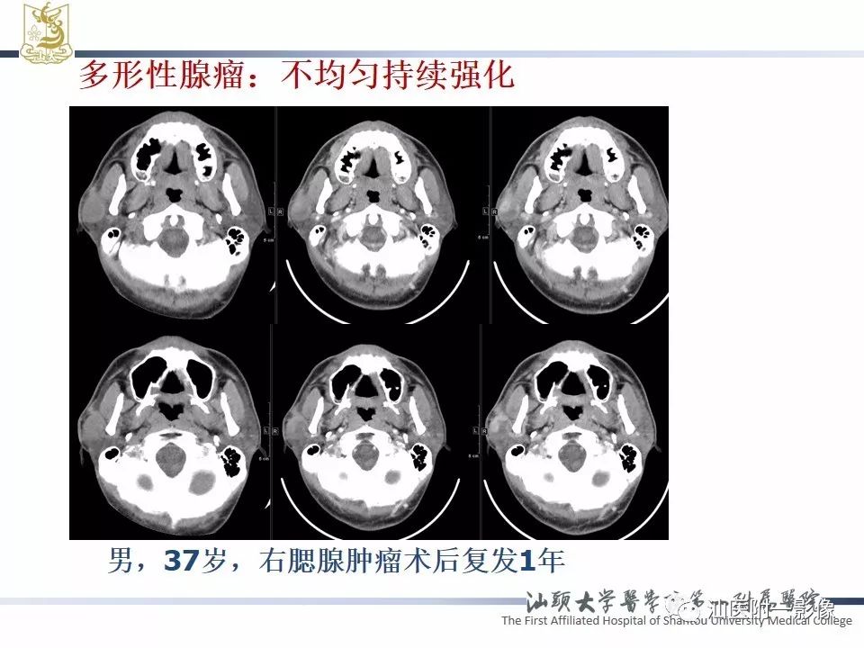 影像PPT - 【PPT】腮腺病变CT诊断-42