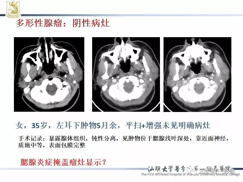 影像PPT - 【PPT】腮腺病变CT诊断-43