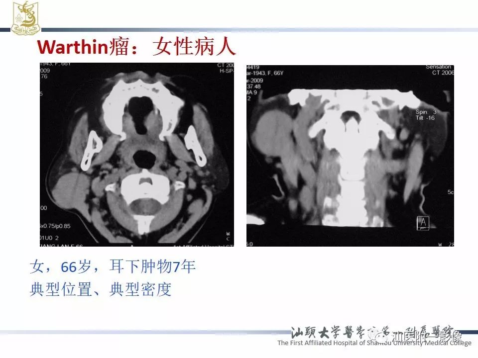 影像PPT - 【PPT】腮腺病变CT诊断-46