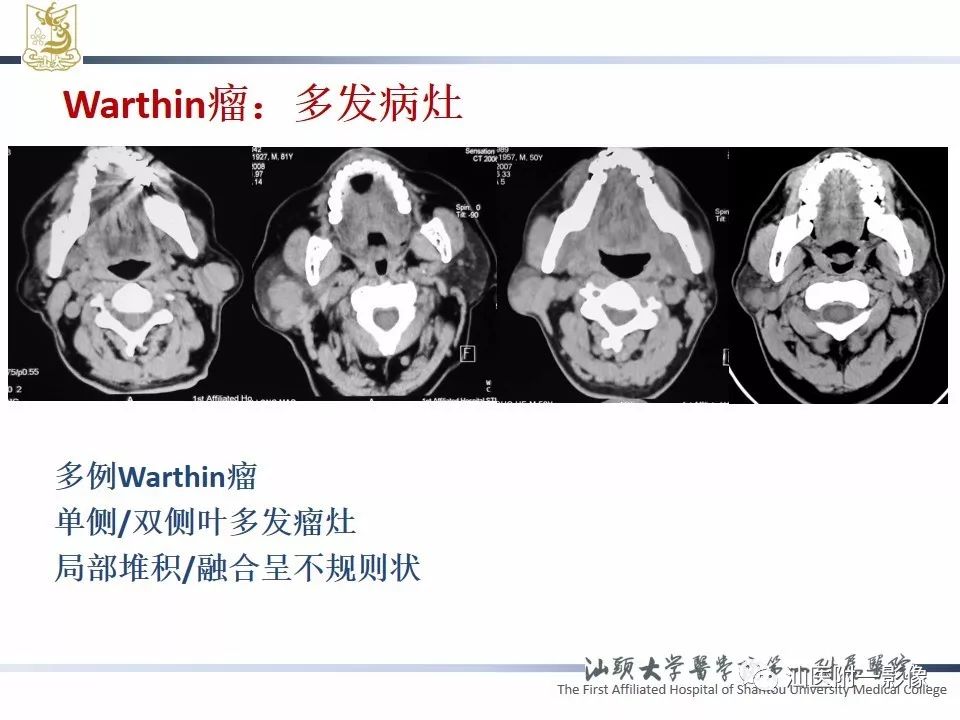 影像PPT - 【PPT】腮腺病变CT诊断-47