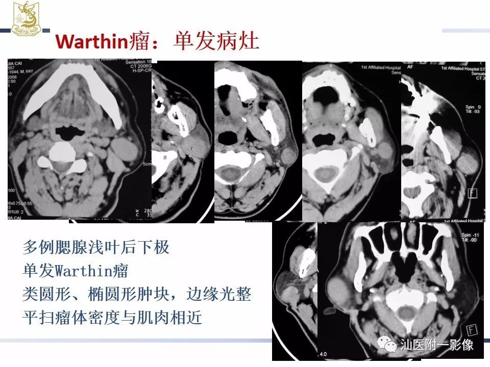 影像PPT - 【PPT】腮腺病变CT诊断-48