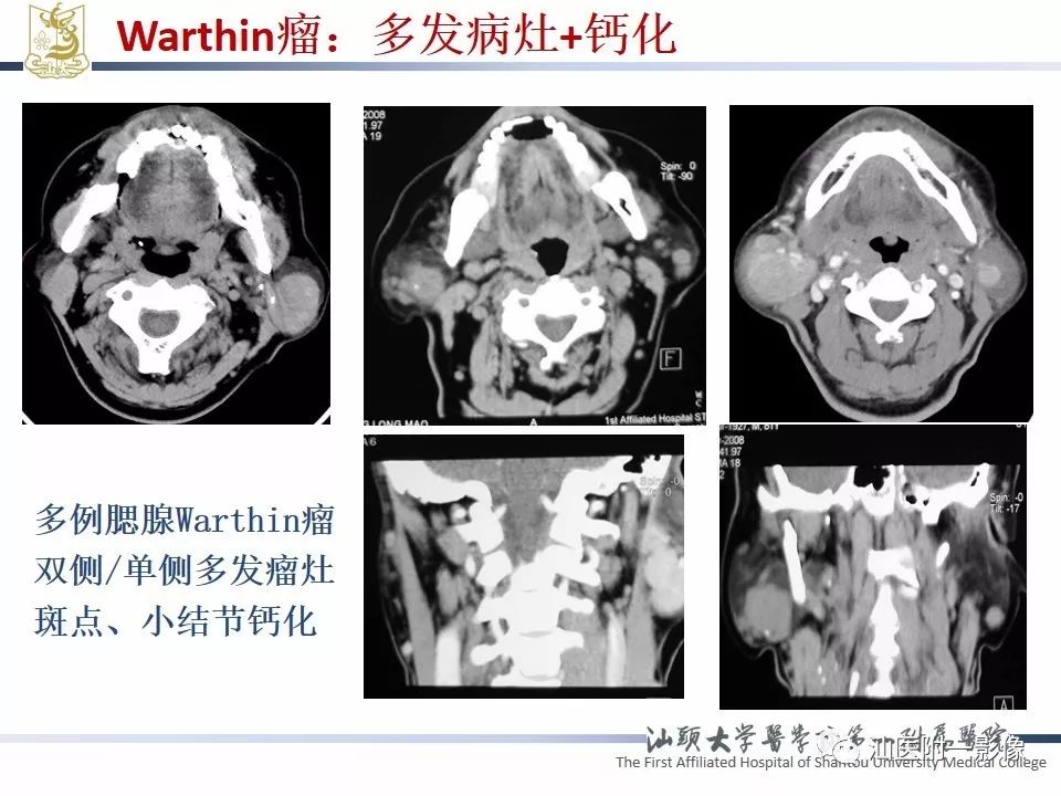 影像PPT - 【PPT】腮腺病变CT诊断-49